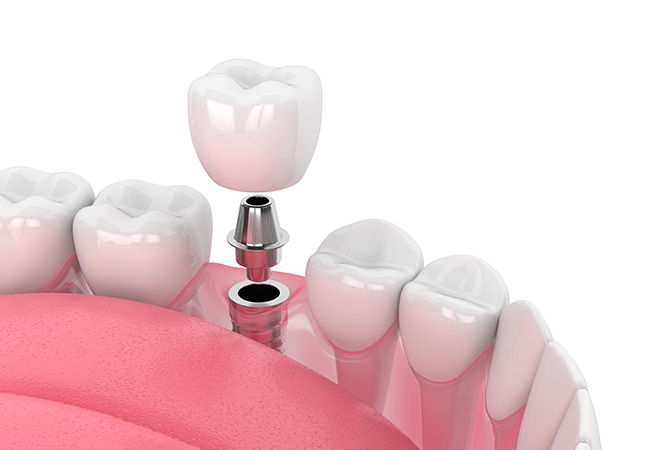 インプラントイメージ